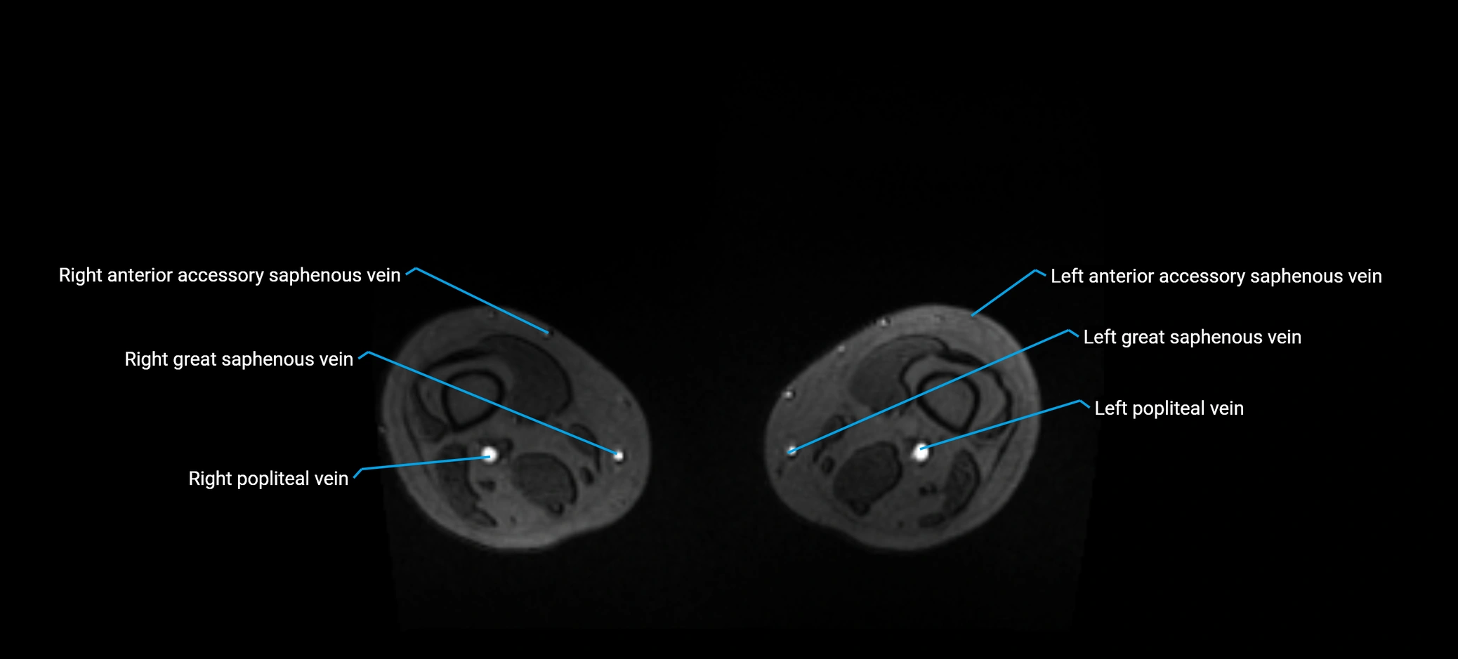 MRV abdomen pelvis & lower limb axial cross sectional anatomy labelled MRI image 337.webp